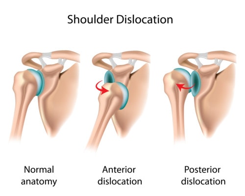 Shoulder Dislocation Surgery