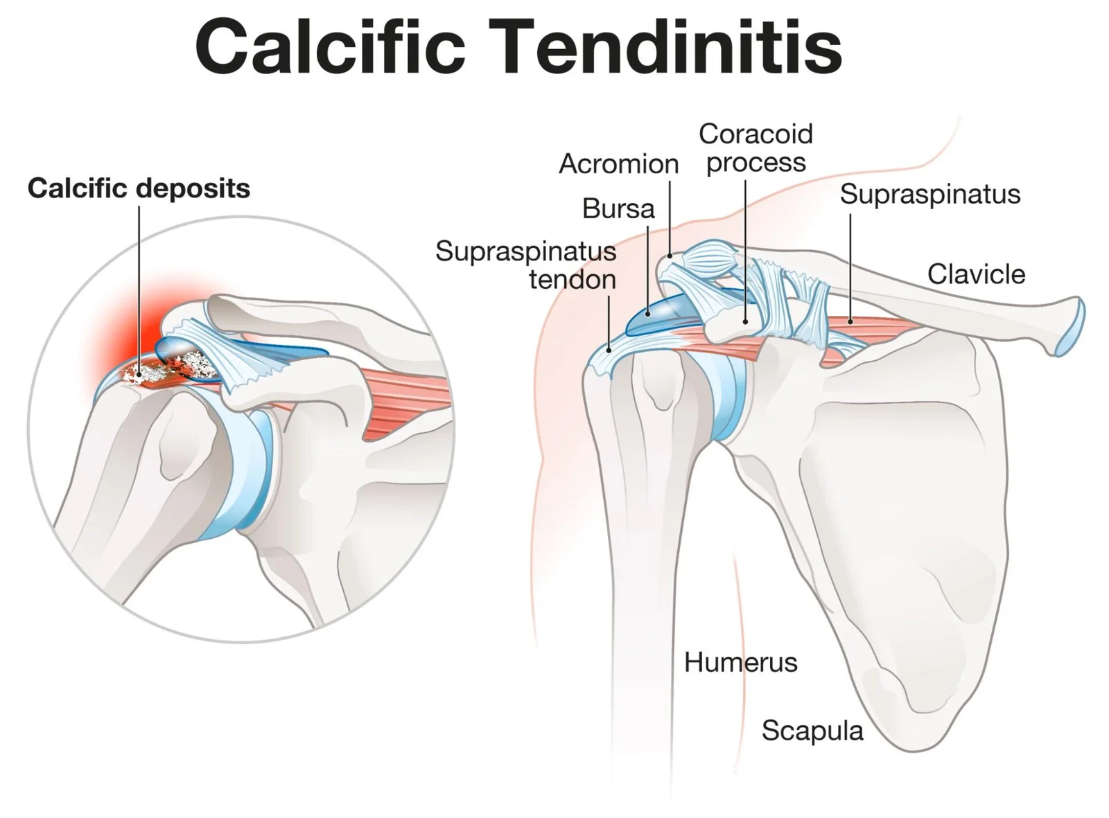 Calcific Tendonitis