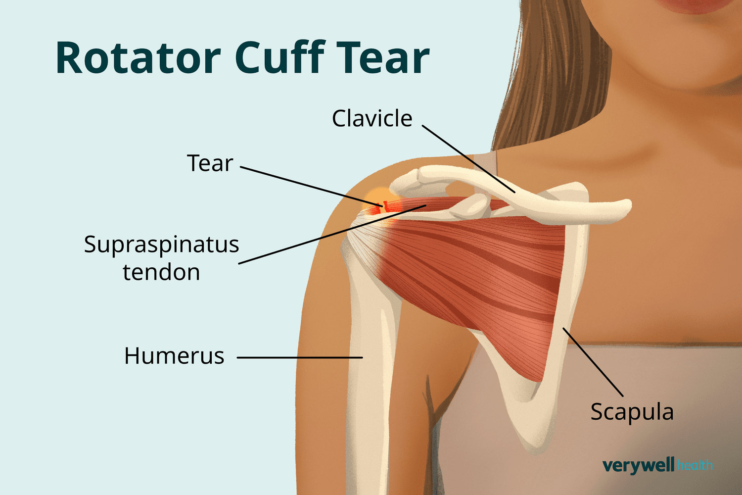 Rotator Cuff Injury