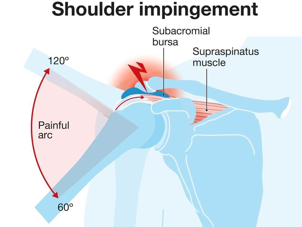 Shoulder Impingement Syndrome