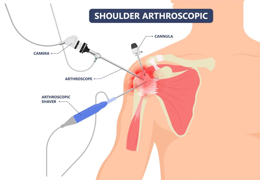 What is Arthroscopic Shoulder Surgery?