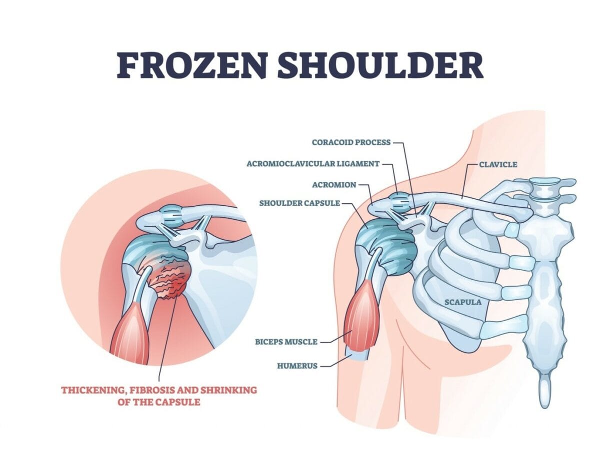 Understanding Frozen Shoulder