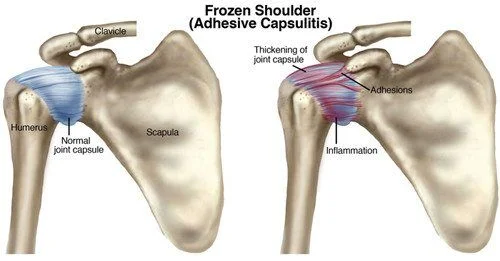 What is Frozen Shoulder?