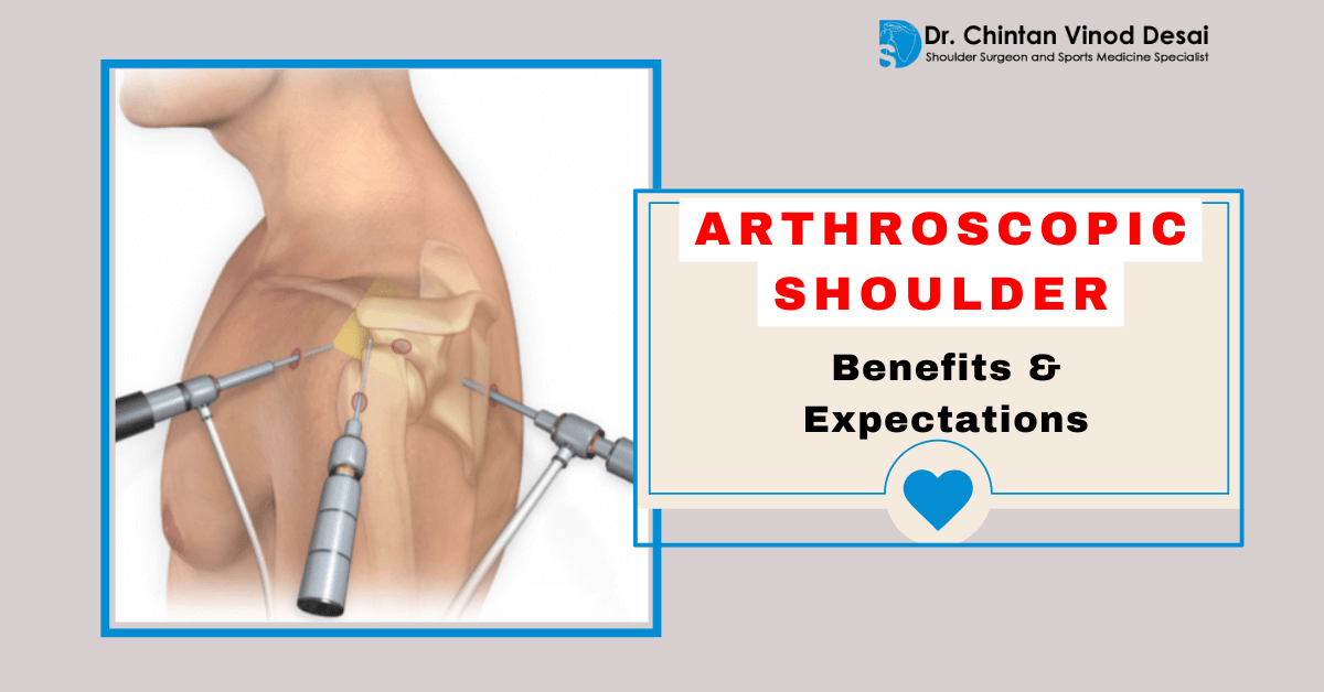 Is Arthroscopic Shoulder Surgery Right for You? Benefits & Expectations
