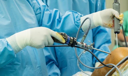 Arthroscopic Shoulder Surgery