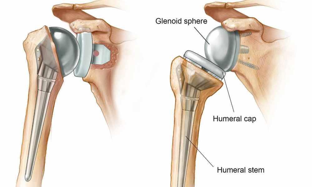What is Shoulder Replacement Surgery?