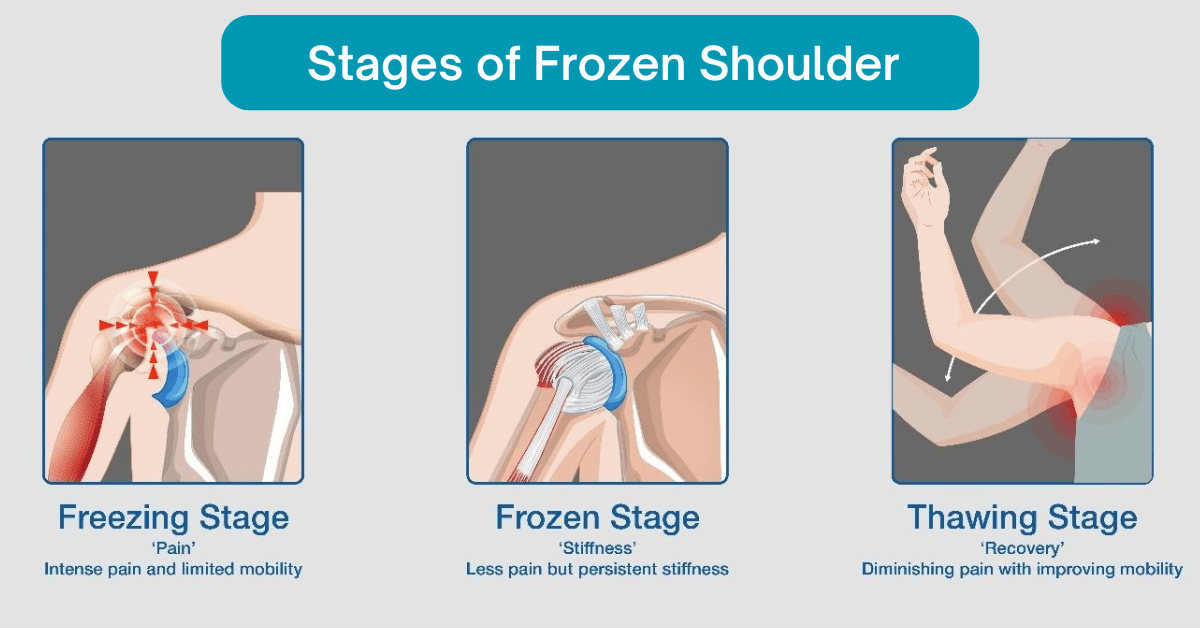 Stages of Frozen Shoulder 
