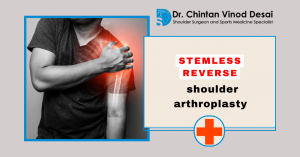 Read more about the article Stemless Reverse Shoulder Arthroplasty: What You Need to Know