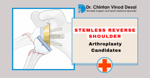Read more about the article Who Is a Candidate for Stemless Reverse Shoulder Arthroplasty?