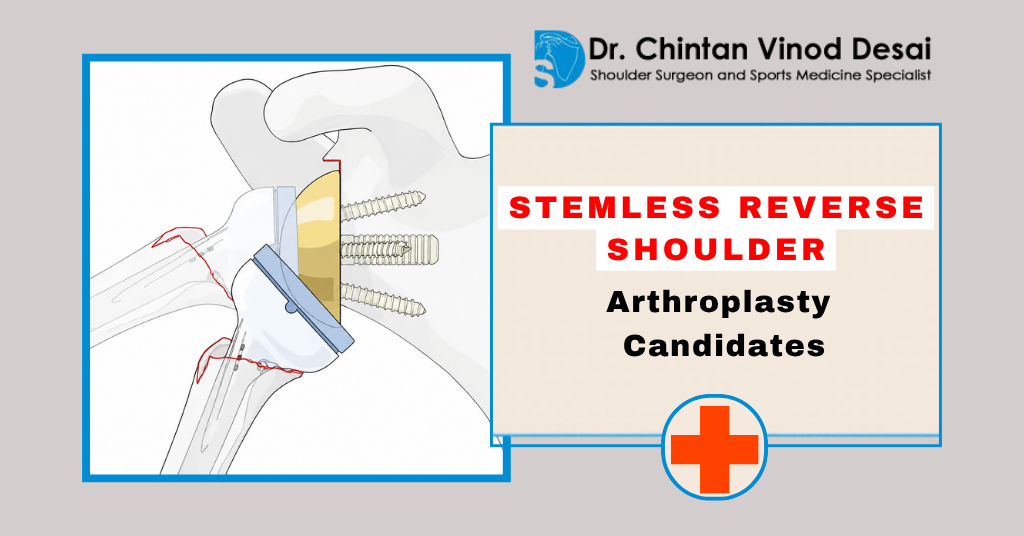 Who Is a Candidate for Stemless Reverse Shoulder Arthroplasty?