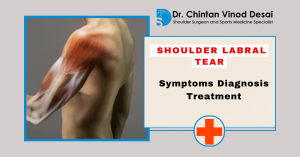 Read more about the article Shoulder Labral Tear: Symptoms, Diagnosis, and Treatment