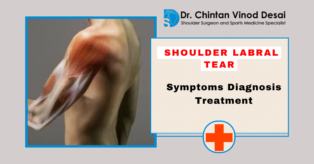 Shoulder Labral Tear: Symptoms, Diagnosis, and Treatment