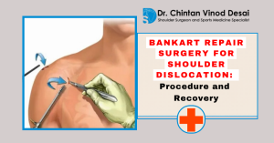 Read more about the article Bankart Repair Surgery for Shoulder Dislocation: Procedure and Recovery