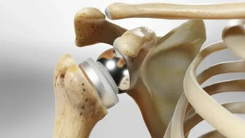 Shoulder Arthroscopy Cost in Mumbai: Factors That Affect Treatment Expenses