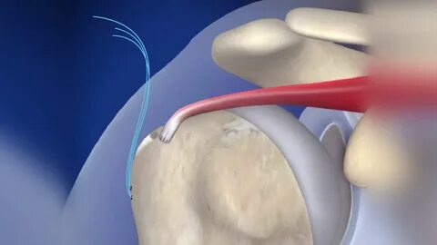 irreparable rotator cuff tear does not mean that treatment options are exhausted.