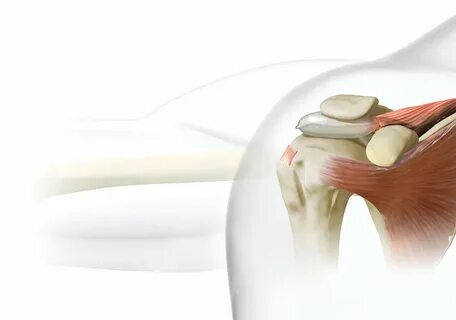 What Causes an Irreparable Rotator Cuff Tear?