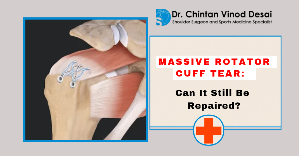 Read more about the article Massive Rotator Cuff Tear: Can It Still Be Repaired?